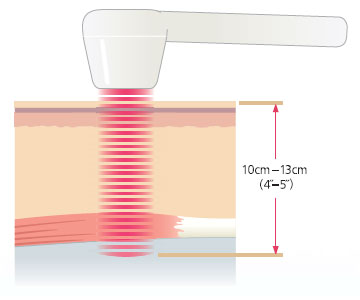 muli-radience-laser-treatment-san-diego